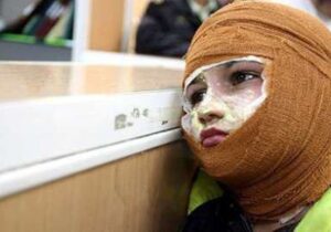 پیامدهای بی‌توجهی به ایمنی و هزینه‌های سنگین پانسمان سوختگی