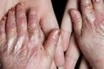 ضرورت حمایت بیمهای از بیماران نادر