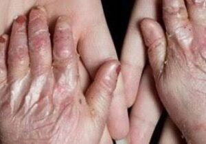 ضرورت حمایت بیمهای از بیماران نادر